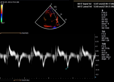Recho R9 Automated Cardiac Function Analysis - Auto DFR image