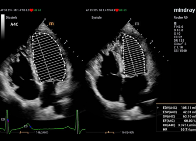 Recho R9 Automated Cardiac Function Analysis - AutoEF image