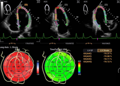 Recho R9 Automated Cardiac Function Analysis - Auto Strain LV image