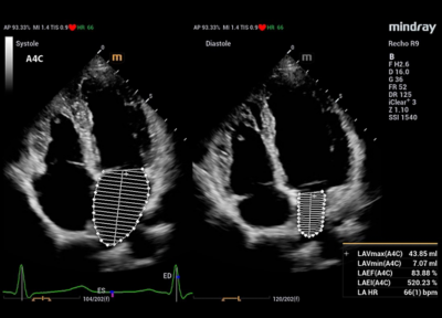 Recho R9 Automated Cardiac Function Analysis - Auto VQLA image
