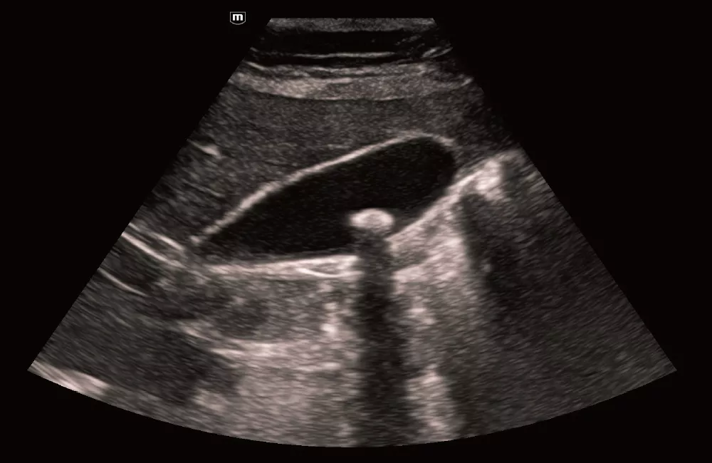 Image clinique TE Air e5M - Vésicule biliaire avec iTouch+