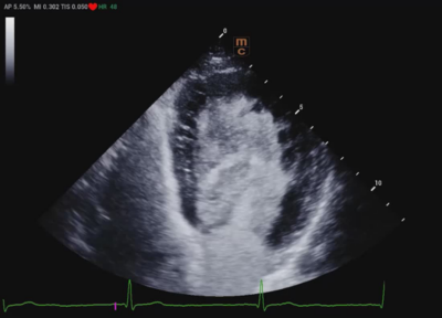 Recho R9 Contrast-enhanced Echocardiography - LVO image