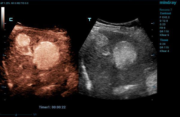 Mindray_RE7_SC5-1U_contrast_2018-03-12_01c_WEB-600x393