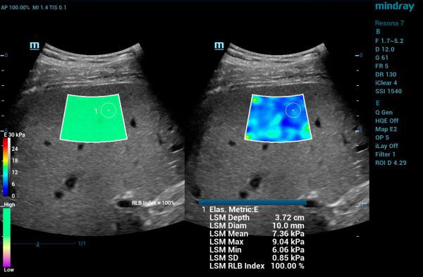 Mindray_RE7_SC6-1U_STE_2018-03-12_01c_WEB-600x393