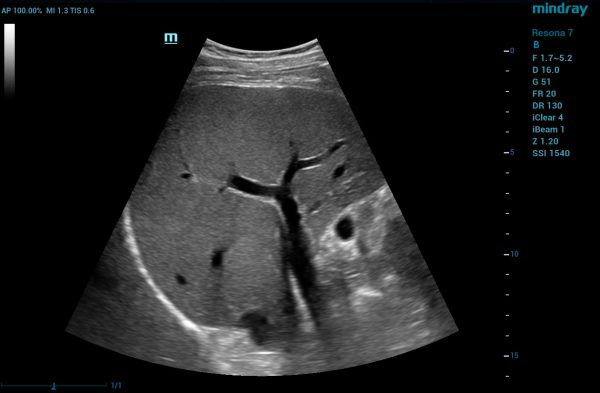 Mindray_RE7_SC6-1U_liver_2018-03-12_01c_WEB-600x393