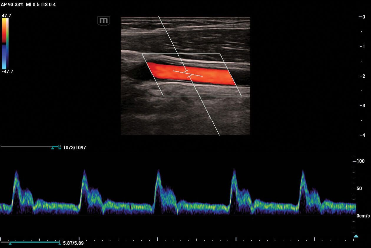 Pulsed-Wave-Doppler-of-Common-Carotid-Artery
