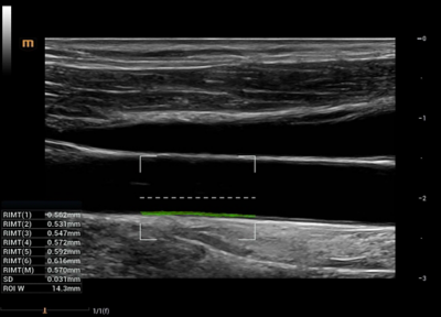 Recho R9 Vascular Function Assessment - RIMT image