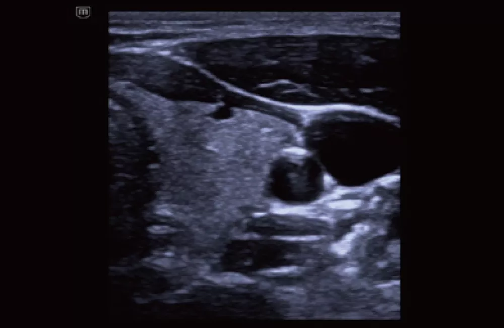 Image clinique TE Air e5M - Thyroïde avec iTouch+