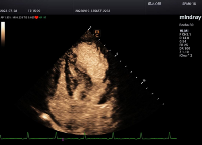 Recho R9 Contrast-enhanced Echocardiography - VLMI Contrast image