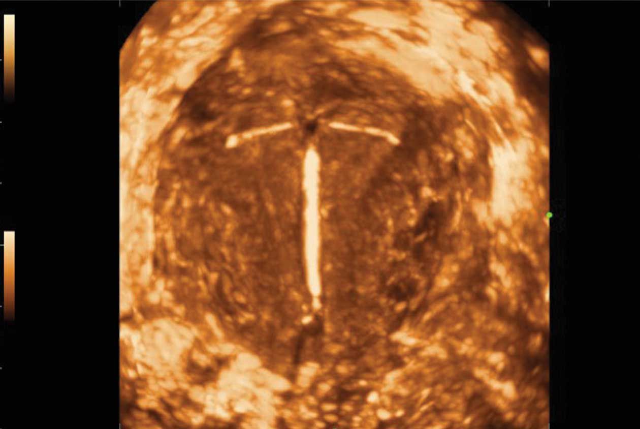 Volume rendering intrauterine