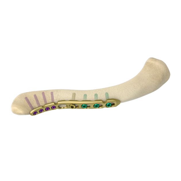 锁骨前侧万向锁定板