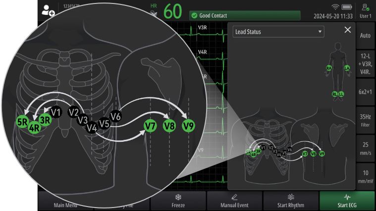 BeneHeart R700/R900 Electrocardiograph - Additional Leads Guidance
