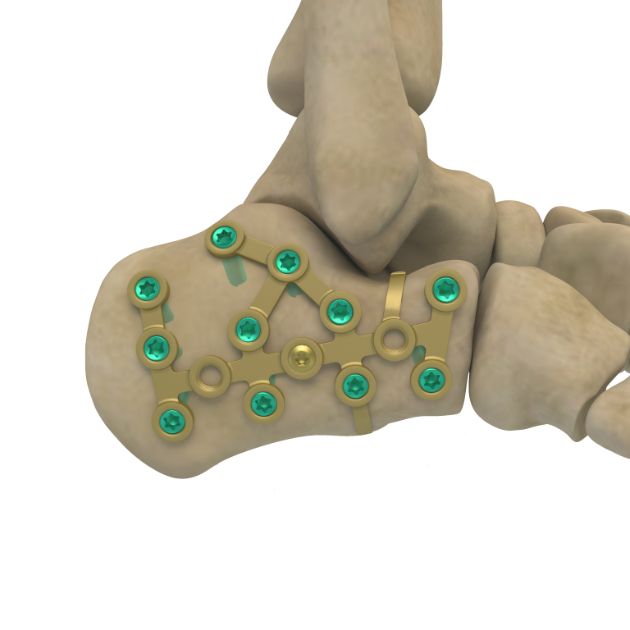 Locking Plate - Calcaneus