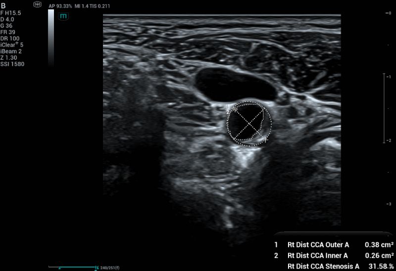 Measuring percentage of stenosis using area-based method. This method manually trace the full vessel lumen and patented lumen in axial plane.