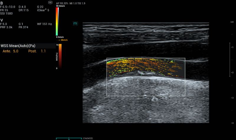 Auto WSS were measured at the stenosis providing valuable parameter for plaque evaluation.
