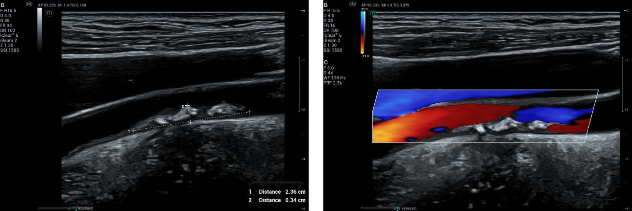 B mode and CF images of the right carotid plaque.