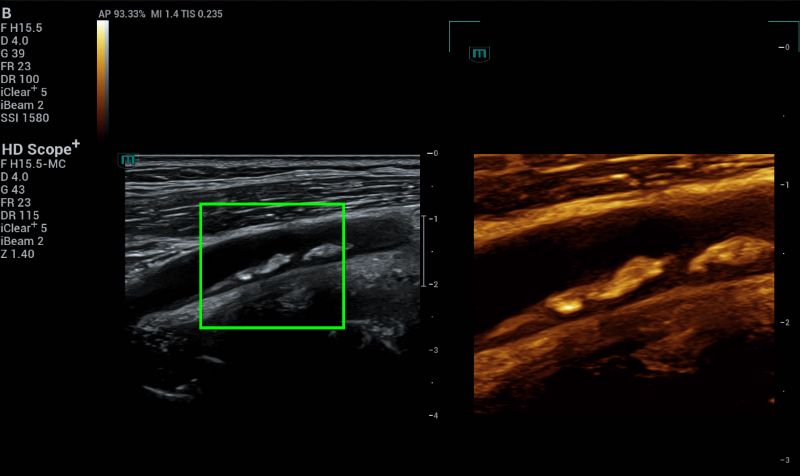 B mode HD Scope+ on the plaque to evaluate the plaque morphology.