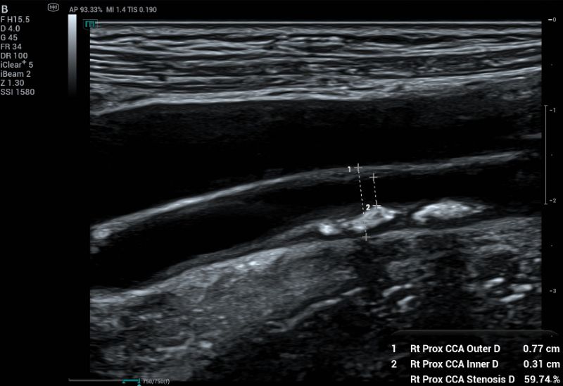 Measuring percentage of stenosis using diameter-based method.  This method measures the full vessel lumen and patented lumen.