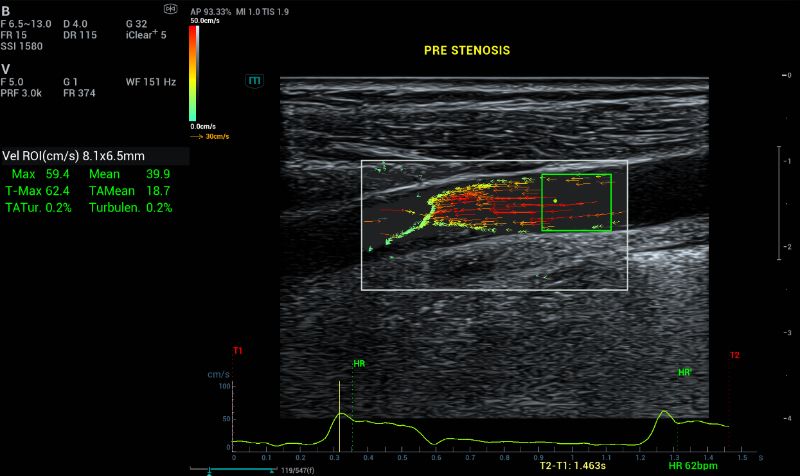 Reverse & turbulence flow are demonstrated by the arrow going towards different directions. Higher velocity are seen with red and longer arrow at the stenosis site.