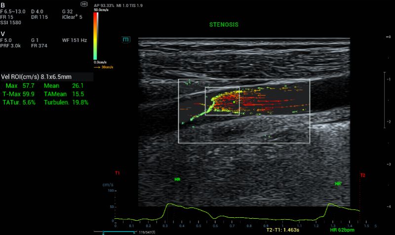 ROI box was placed at the stenosis to measure the Tur. The quantitative instantaneous velocity values is calculated based on the movement of the RBC through the transmission and reception of plane waves.