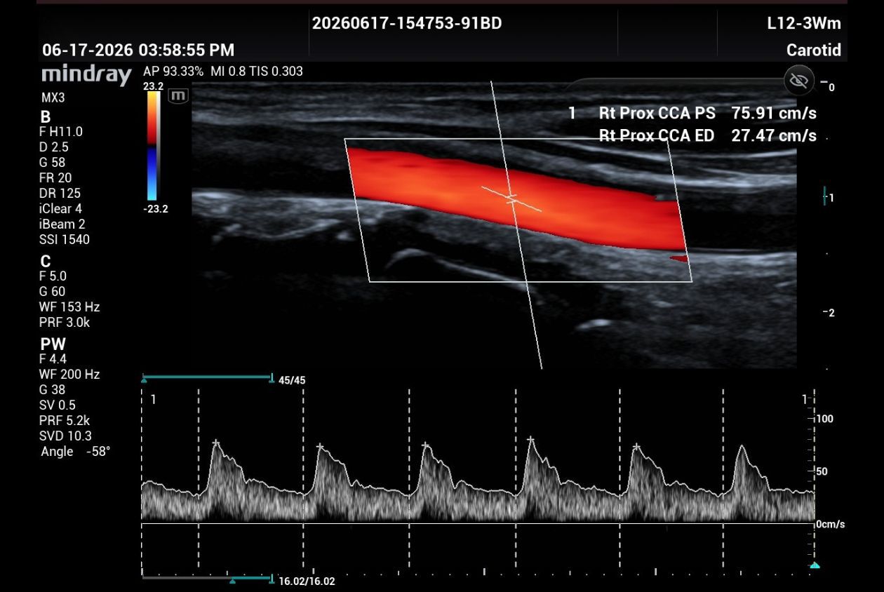 Color doppler common carotid artery