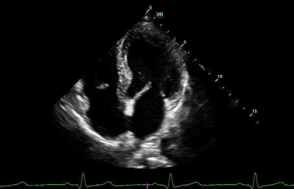 consona-n5-clinical-image-cardiac-4ch-1.0-en