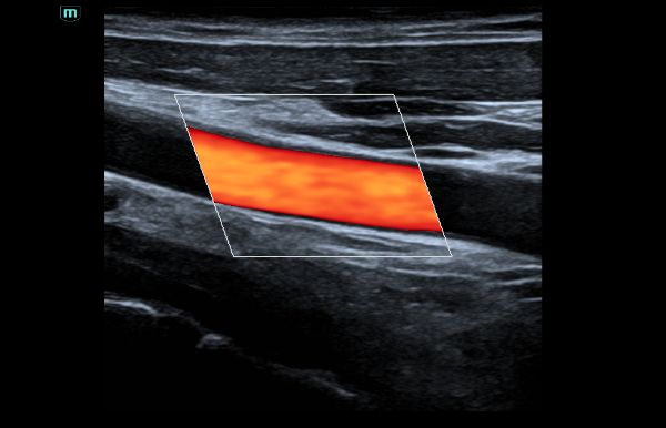 consona-n5-clinical-image-carotid-cdi-1.0-en