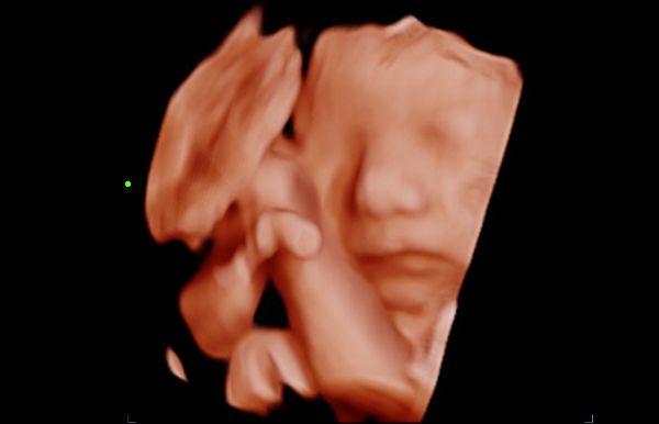 consona-n5-clinical-image-fetal-face-3d-1.0-en