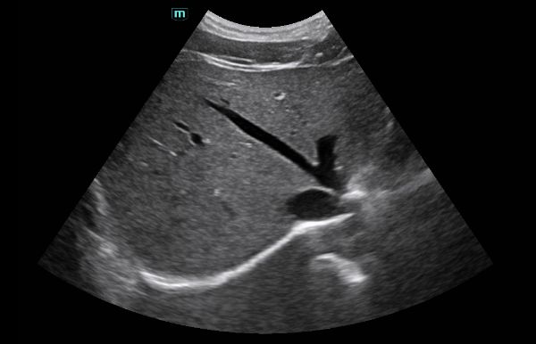 consona-n5-clinical-image-porta-hepatis-1.0-en