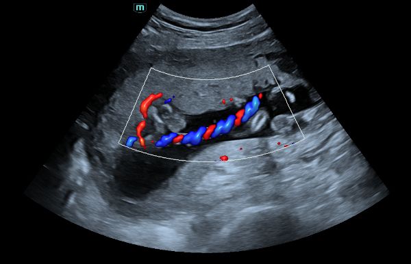 consona-n5-clinical-image-umbilical-cord-flow-1.0-en