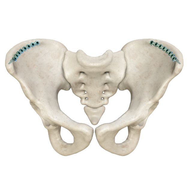 Locking Plate - Pelvis