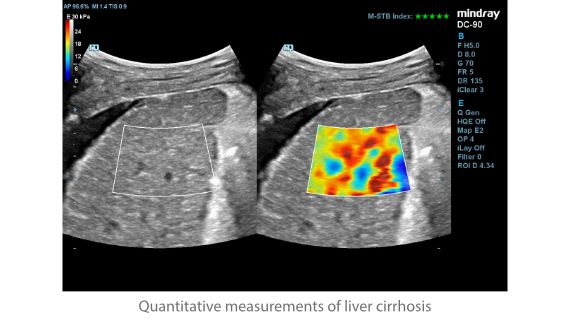 DC-90 rad STE liver-cirrhosis SC6-1E