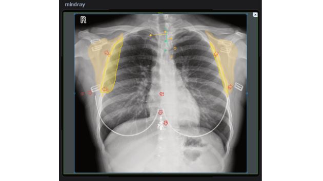 凌云 DigiEye U 系列数字化摄影X射线系统 - AI图像质量评价