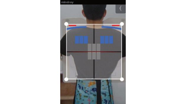 凌云 DigiEye U 系列数字化摄影X射线系统 - 规范化AI摆位助手