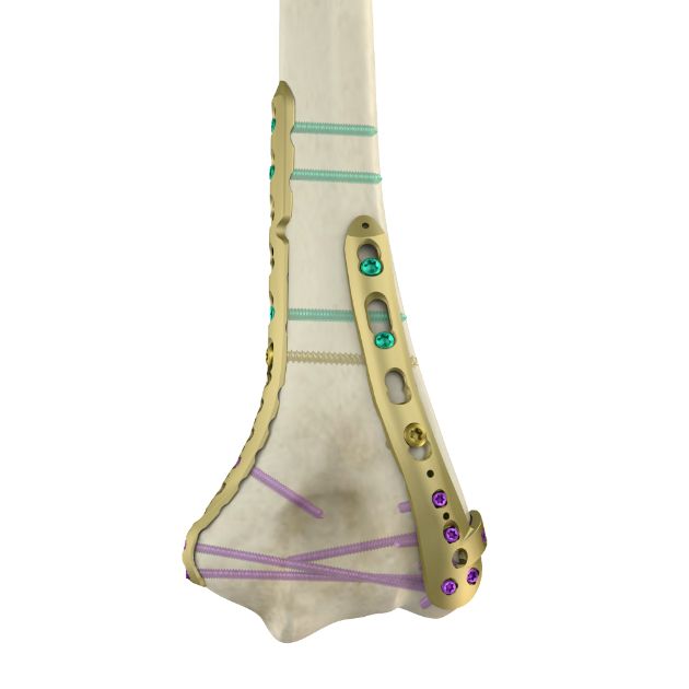 肱骨远端内外侧万向锁定板系统