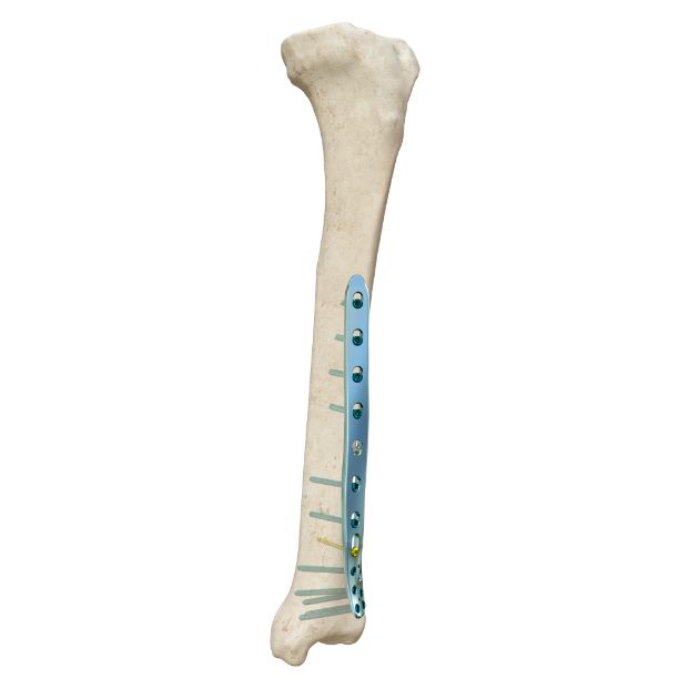 Locking Plate - Tibia