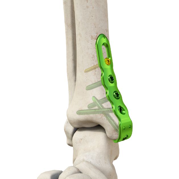 胫骨远端钩锁定板T