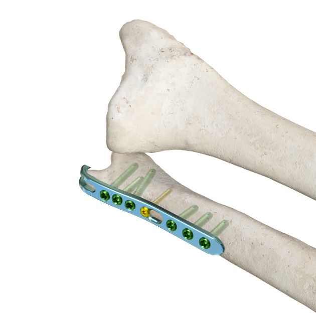 尺骨远端钩锁定板