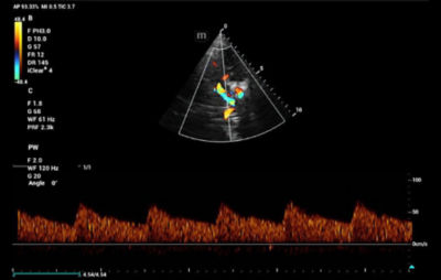 Intrauterine blood clot, Radiology Reference Article