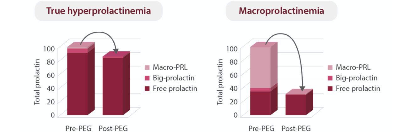 True hyperprolactinemia and Macroprolactinomia comparison