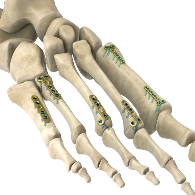 Locking Plate - Foot