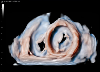 Recho R9 Real-time 3D Cardiac lmaging - iLive Echo image
