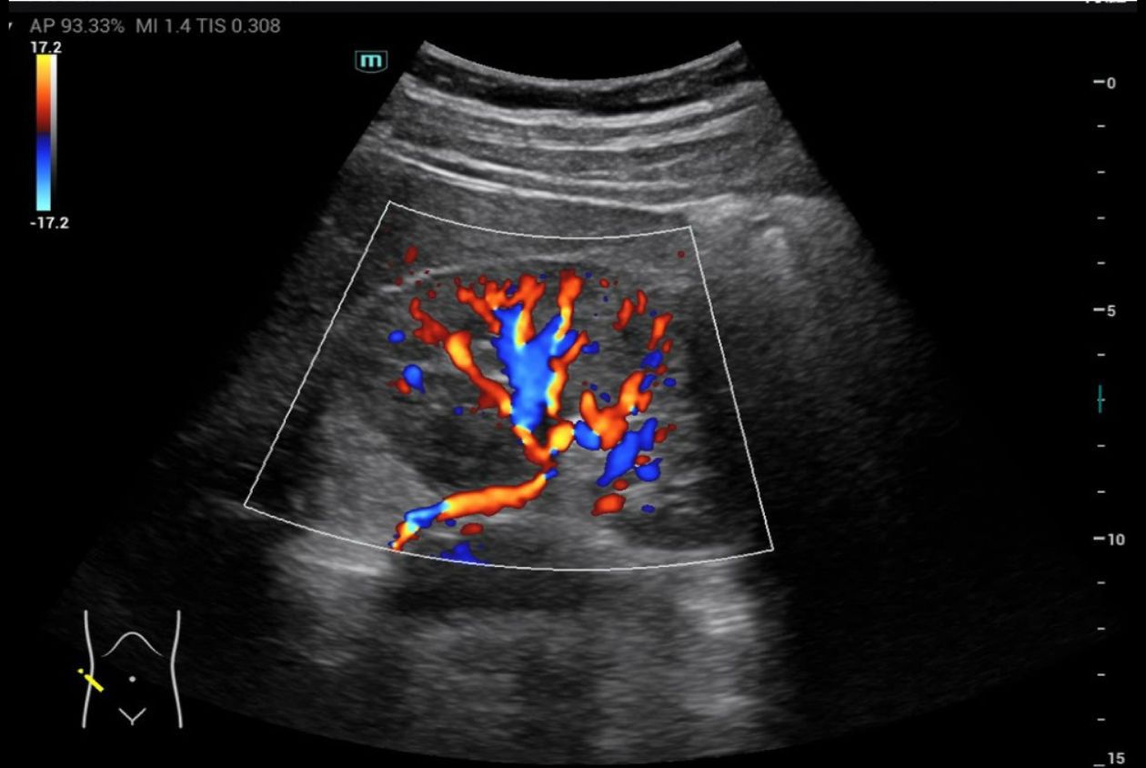 Kidney with glazing flow