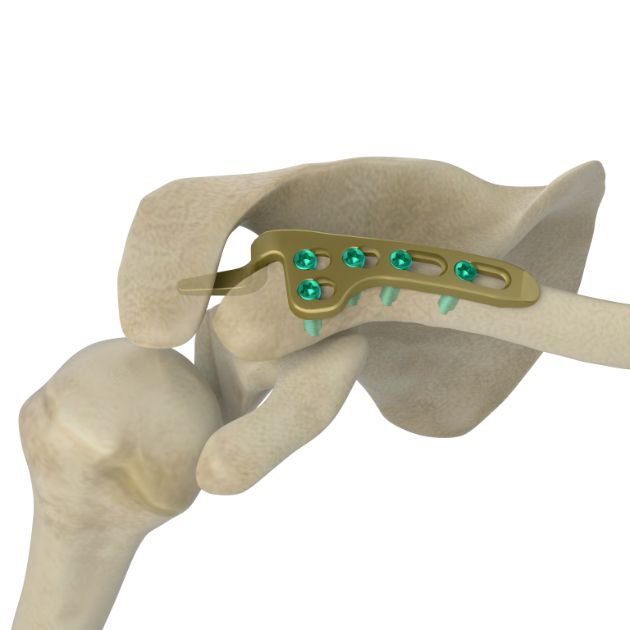 Locking Plate - Clavicle