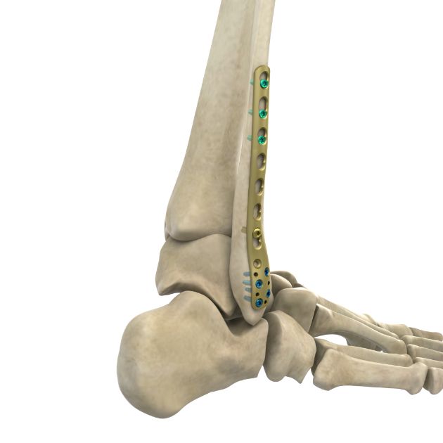 Locking Plate - Fibula