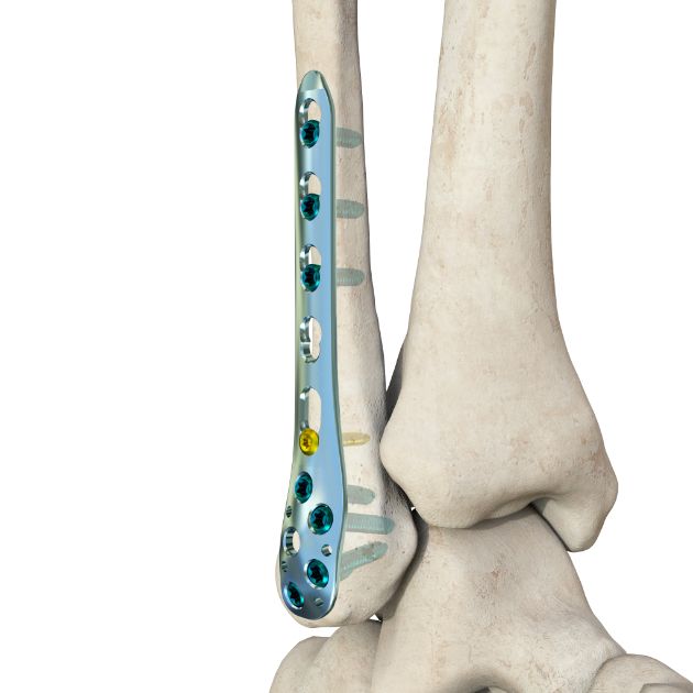 Locking Plate - Fibula