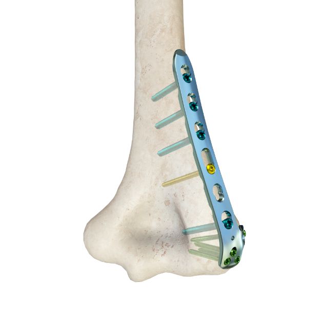Locking Plate - Humerus
