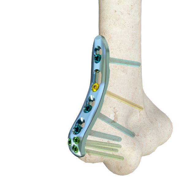Locking Plate - Humerus