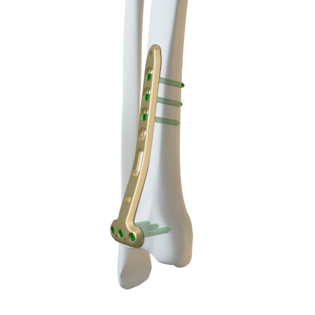 Locking Plate - Tibia