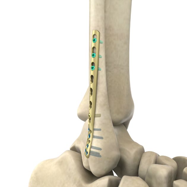 Locking Plate - Fibula